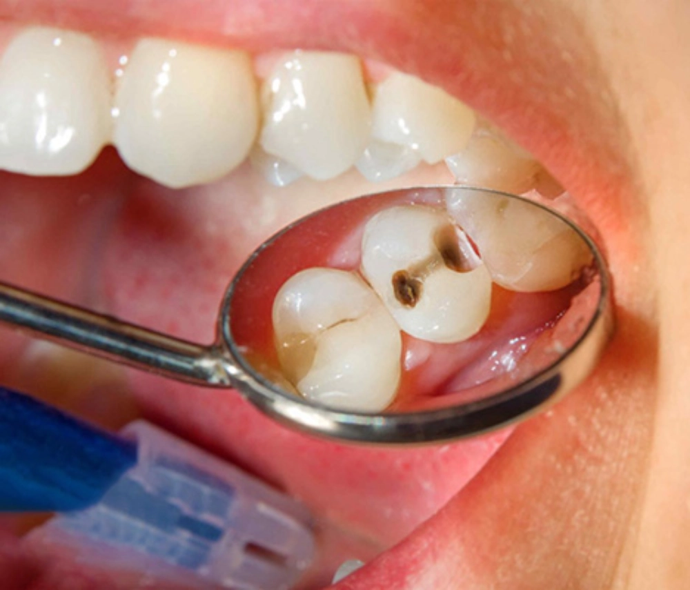 Bọc răng sứ cho răng sâu: Lợi ích, quy trình và chi phí